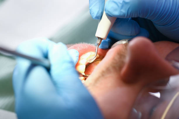 Best Emergency Treatment for Toothache in Abbeville, GA